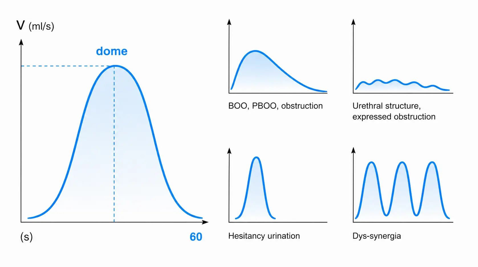 Example uroflow chart showing bell-shaped, plateau, and staccato patterns